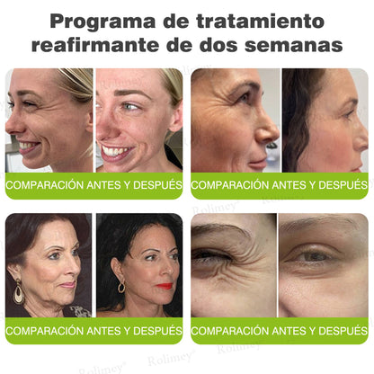 Fabricado y enviado desde España 👨‍⚕️Rolimey® Botox & Vita-A Retinol Shot Crema reafirmante y lifting antiarrugas - Promoción de último día 50% de descuento